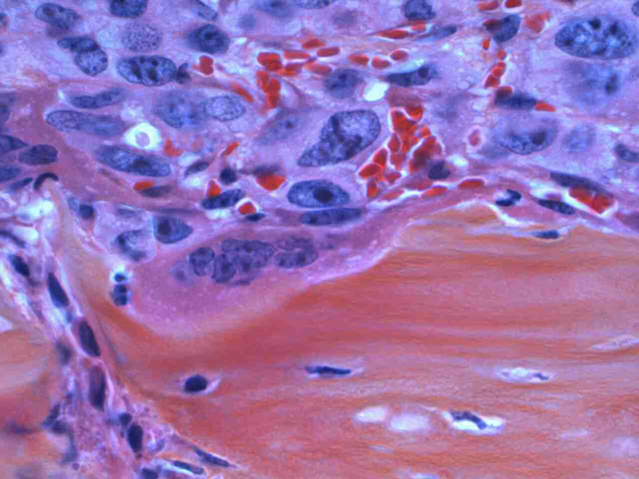 Cancer Spreading