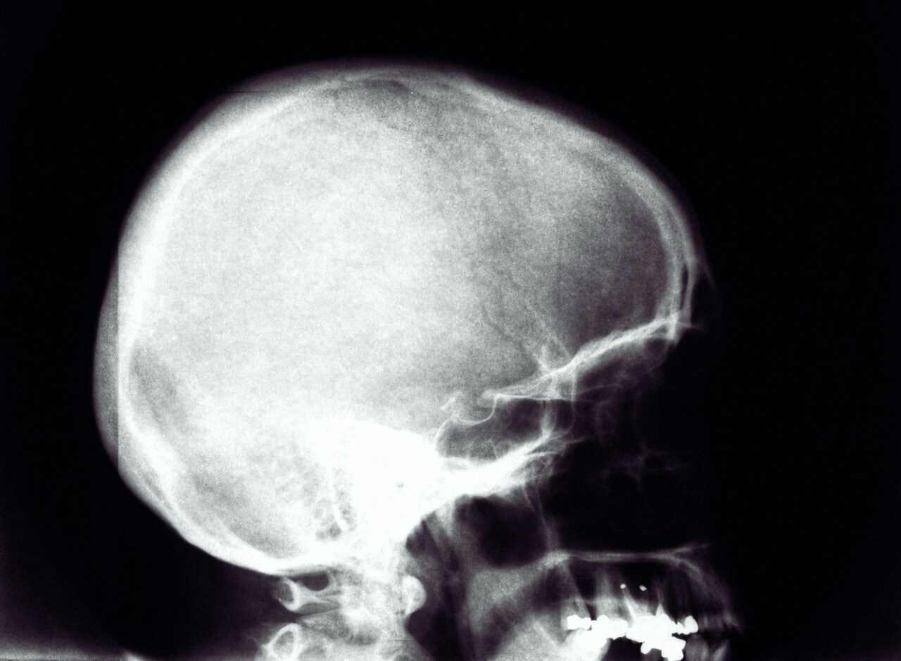 skull and brain scan
